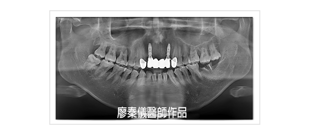  晶鑽牙橋,全口重建,ALL ON 4 全口植牙,人工植牙,牙齒美容,牙齒美白