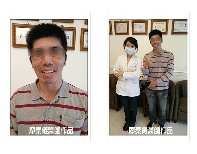 晶鑽牙橋,全口重建,ALL ON 4 全口植牙,人工植牙,牙齒美容,牙齒美白
