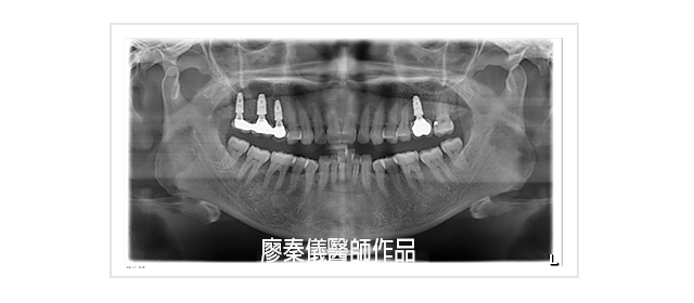 無痛植牙,竹北無痛植牙,舒眠植牙,雷射牙周治療,雷射植牙,一日植牙,人工植牙