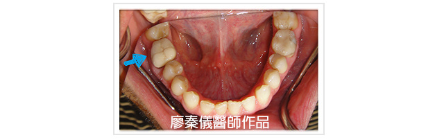 3D齒雕,竹北3D齒雕,美容牙科,前牙斷裂修復
