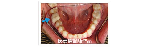 3D齒雕,竹北3D齒雕,美容牙科,前牙斷裂修復