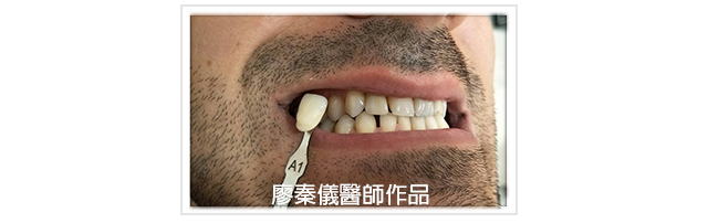 3D齒雕,竹北3D齒雕,美容牙科,前牙斷裂修復