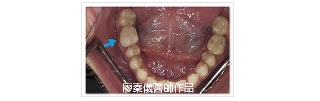 3D齒雕,竹北3D齒雕,美容牙科,前牙斷裂修復