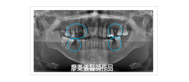 舒眠植牙,無痛植牙,TCI舒眠牙醫治療,TCI舒眠植牙,無痛植牙,新竹缺牙,新竹牙齒缺牙,竹北缺牙,竹北牙齒缺牙