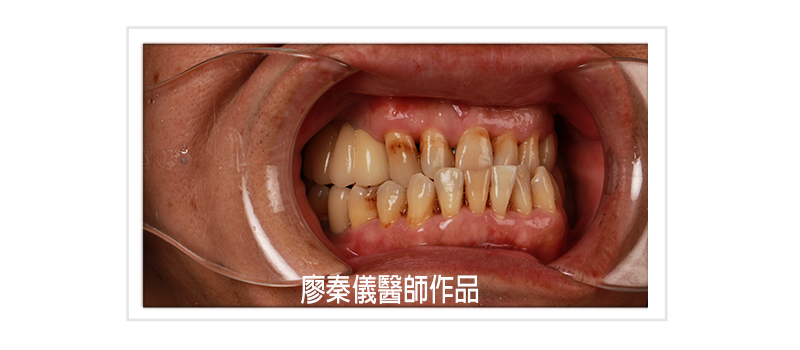舒眠植牙,無痛植牙,TCI舒眠牙醫治療,TCI舒眠植牙,無痛植牙,新竹缺牙,新竹牙齒缺牙,竹北缺牙,竹北牙齒缺牙