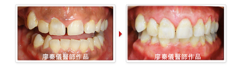 快速矯正,晶鑽全瓷,雷射牙周治療,雷射植牙