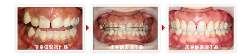  快速矯正,晶鑽全瓷,雷射牙周治療,雷射植牙