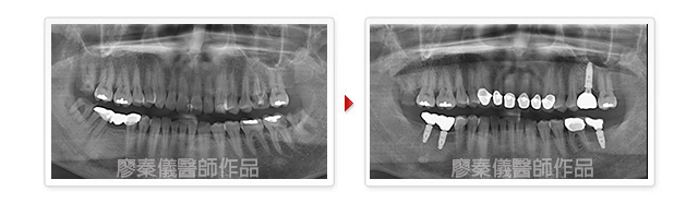 3D齒雕,雷射牙周治療,竹北雷射牙周治療,雷射植牙,竹北雷射植牙,美容牙科