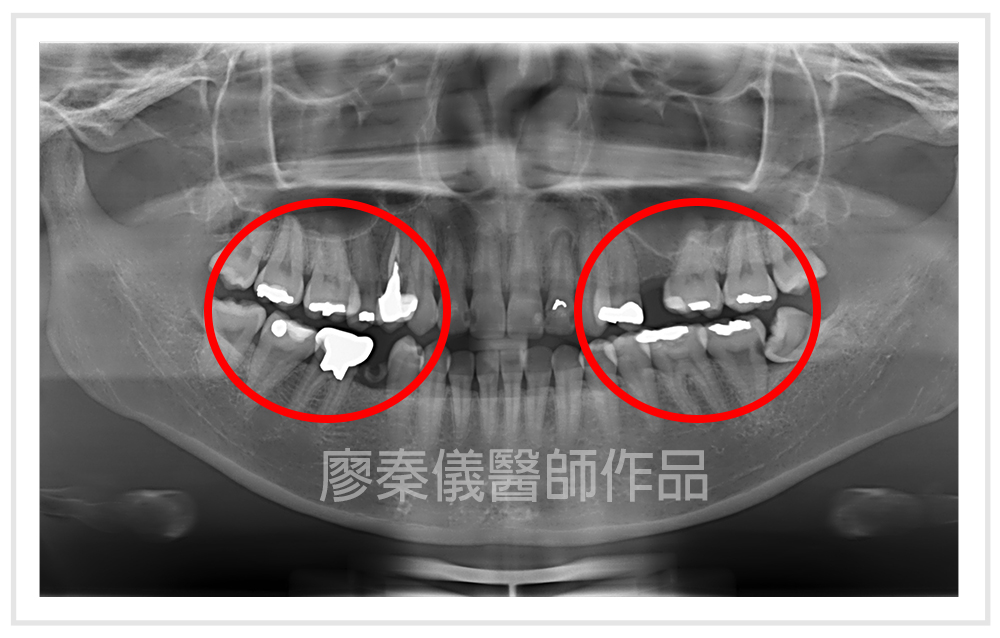 美容牙科,3D齒雕,晶鑽全瓷,牙齒美容,牙齒美白