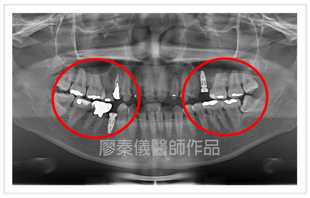 美容牙科,3D齒雕,晶鑽全瓷,牙齒美容,牙齒美白