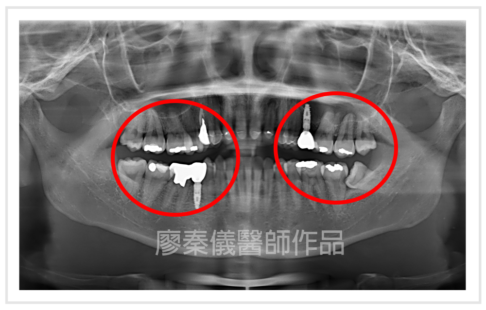 美容牙科,3D齒雕,晶鑽全瓷,牙齒美容,牙齒美白