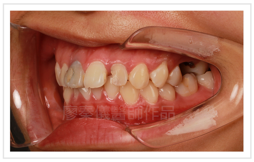 美容牙科,3D齒雕,晶鑽全瓷,牙齒美容,新竹牙斷,新竹牙裂,竹北牙斷,竹北牙裂