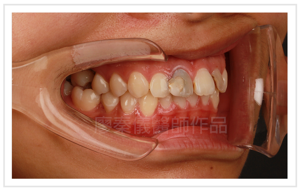 竹北牙裂,美容牙科,3D齒雕,晶鑽全瓷,牙齒美容,新竹牙斷,新竹牙裂,竹北牙斷,竹北缺牙