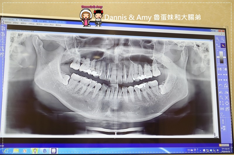 3D齒雕,美容牙科,晶鑽全瓷,即拔即種植牙