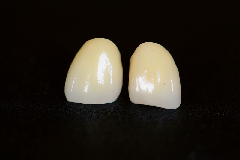 3D齒雕,美容牙科,晶鑽全瓷,即拔即種植牙