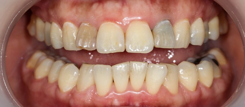 3D齒雕,美容牙科,晶鑽全瓷,即拔即種植牙