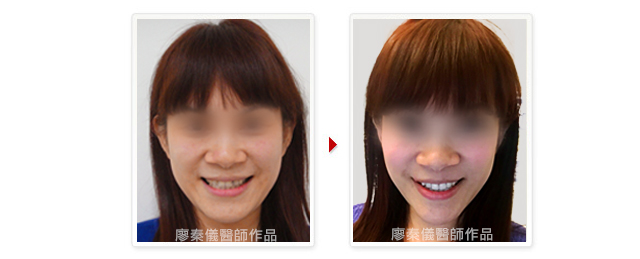 晶鑽全瓷,美容牙科,3D齒雕,三合一植牙