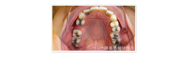 晶鑽全瓷,美容牙科,3D齒雕,三合一植牙