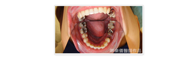 晶鑽全瓷,美容牙科,3D齒雕,三合一植牙