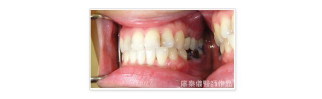 晶鑽全瓷,美容牙科,3D齒雕,三合一植牙