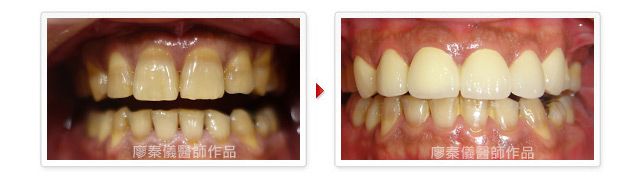晶鑽全瓷,美容牙科,3D齒雕,牙齒美容,牙齒美白