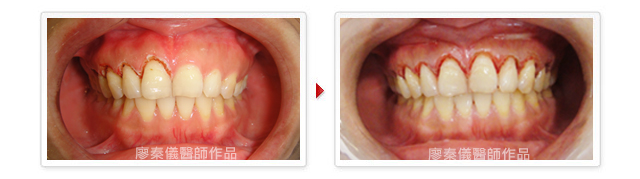 牙齦對稱手術,竹北牙齦對稱手術,雷射植牙,竹北雷射植牙,牙齦美容