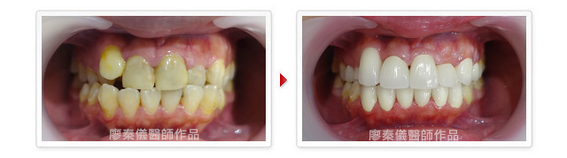 晶鑽全瓷,植牙專科,3D齒雕,美容牙科,牙齒美容,牙齒美白