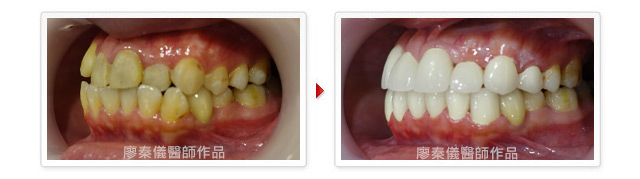 晶鑽全瓷,植牙專科,3D齒雕,美容牙科,牙齒美容,牙齒美白