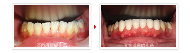 晶鑽全瓷,植牙專科,3D齒雕,美容牙科,牙齒美容,牙齒美白