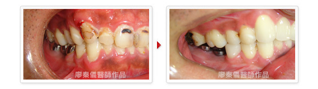 3D齒雕,雷射牙周治療,竹北雷射牙周治療,雷射植牙,竹北雷射植牙,美容牙科