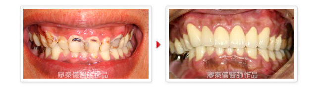 3D齒雕,雷射牙周治療,竹北雷射牙周治療,雷射植牙,竹北雷射植牙,美容牙科