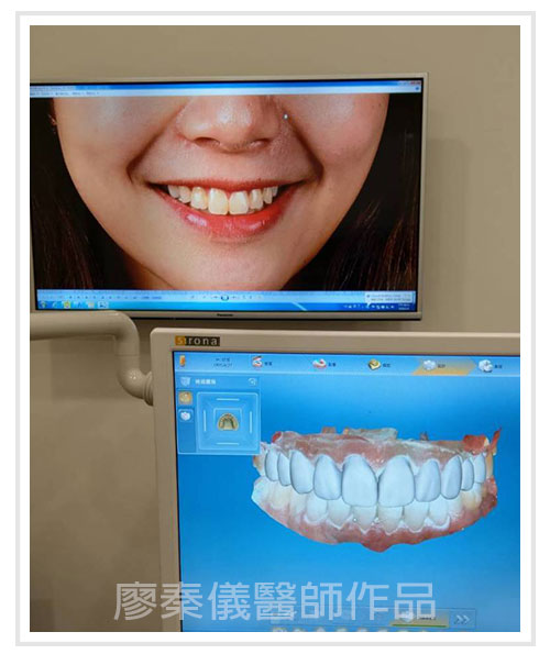 3D齒雕,3d齒雕缺點,美容牙科,竹北牙齒美白