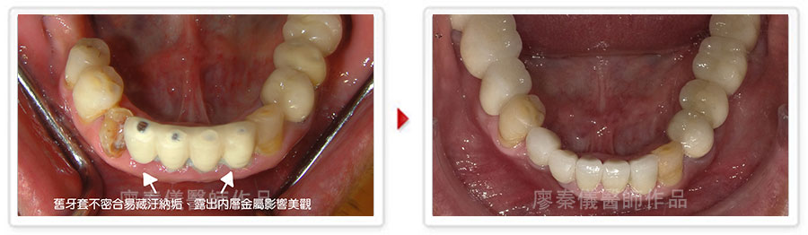 晶鑽全瓷,晶鑽薄型全瓷冠,美容牙科,3D齒雕,三合一植牙,牙齒美容,牙齒美白