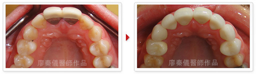 晶鑽全瓷,晶鑽薄型全瓷冠,美容牙科,3D齒雕,三合一植牙,牙齒美容,牙齒美白