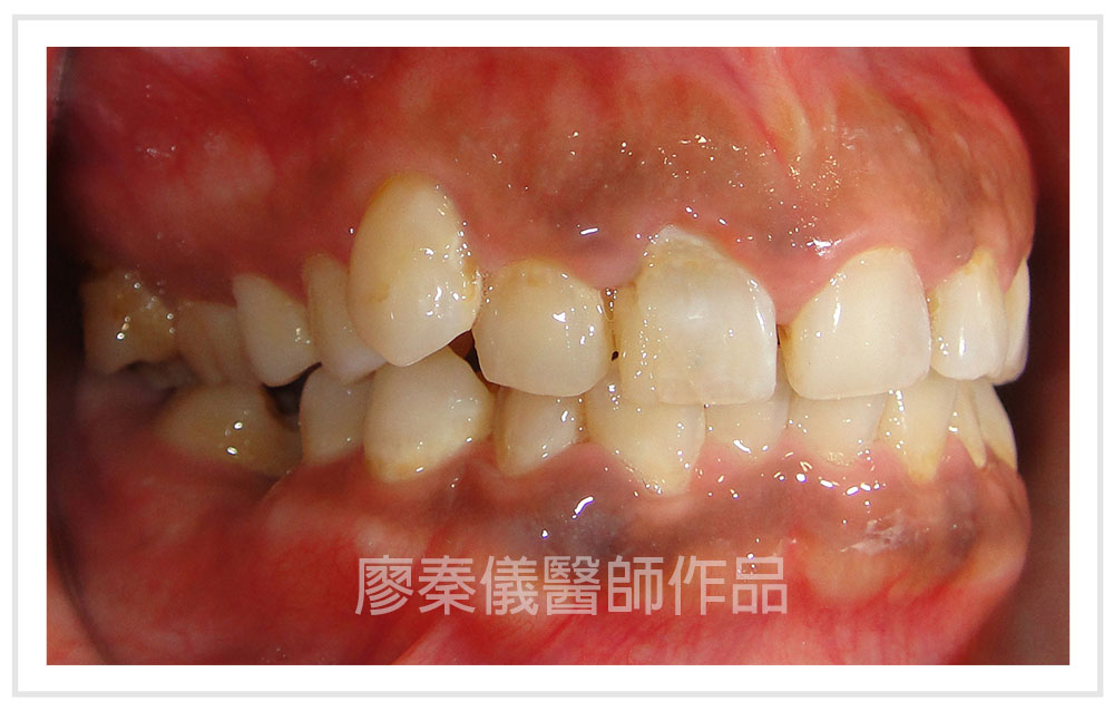 晶鑽全瓷,晶鑽薄型全瓷冠,美容牙科,3D齒雕,三合一植牙,牙齒美容,牙齒美白