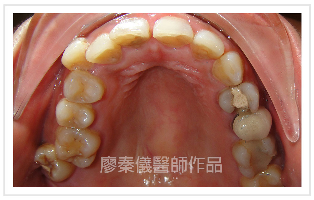 晶鑽全瓷,晶鑽薄型全瓷冠,美容牙科,3D齒雕,三合一植牙,牙齒美容,牙齒美白