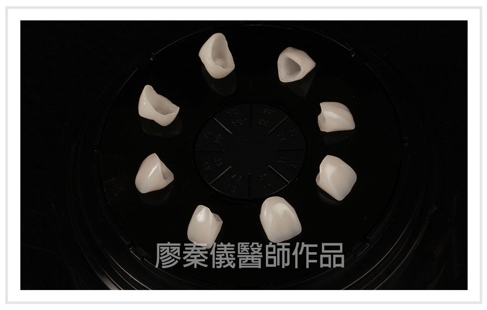 一日完成3D齒雕全瓷冠假牙+美白瓷牙貼片-新竹市牙醫診所推薦 ... 患者實例 真美牙醫診所