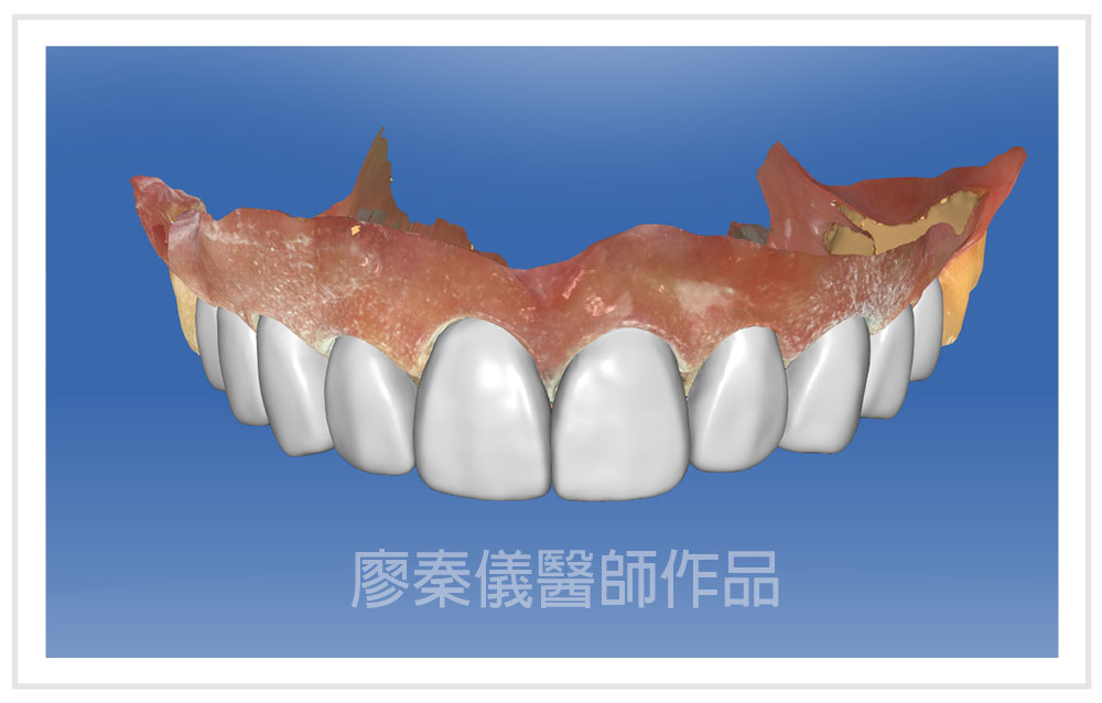 3D齒雕,3D齒雕CEREC,3d齒雕缺點,一日美齒CEREC,美容牙科,竹北牙齒美白
