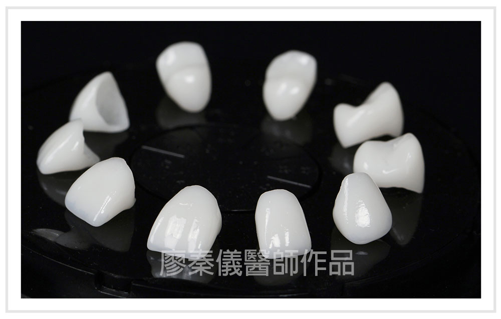 3D齒雕,竹北3D齒雕,美容牙科,3D齒雕門牙,新竹缺牙,竹北缺牙