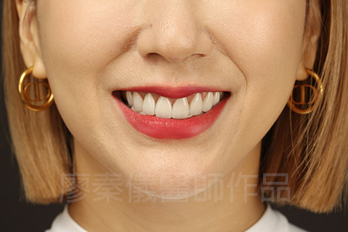 牙齦美容,微笑曲線設計,全瓷貼片