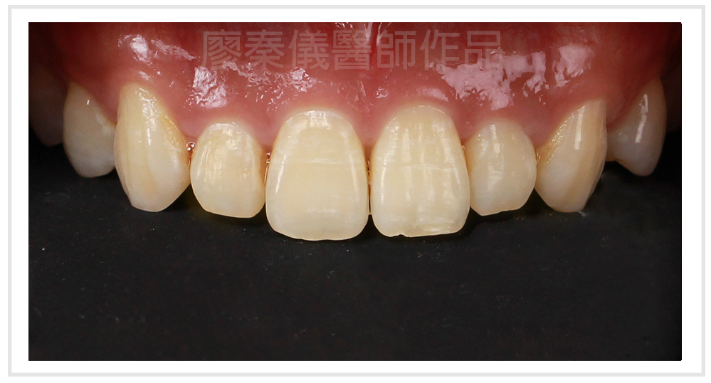 美容牙科,3D齒雕,3d齒雕缺點,晶鑽全瓷,牙齒美容,牙齒美白,竹北牙齒美白