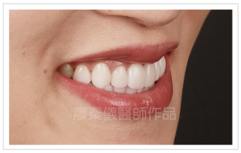 美容牙科,3D齒雕,3d齒雕缺點,晶鑽全瓷,牙齒美容,牙齒美白,竹北牙齒美白