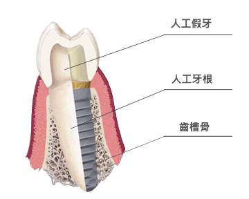 高科技植牙,竹北人工植牙,人工植牙