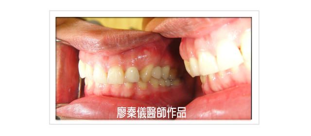 TCI舒眠牙醫治療,TCI舒眠植牙,舒眠植牙,無痛植牙,雷射牙周治療,雷射植牙,三合一植牙,人工植牙
