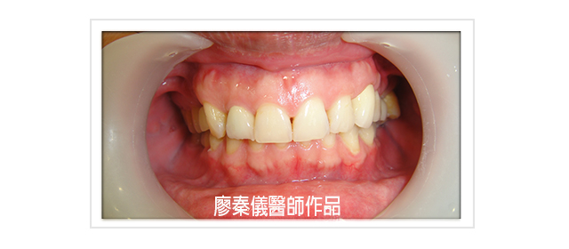 TCI舒眠牙醫治療,TCI舒眠植牙,舒眠植牙,無痛植牙,雷射牙周治療,雷射植牙,三合一植牙,人工植牙