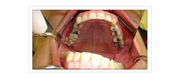 人工植牙、日本禁止植牙來新竹植牙、植牙費用2020、植牙費用2021、台大醫院植牙費用