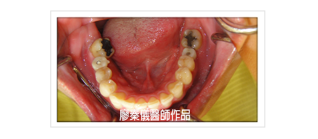 人工植牙、日本禁止植牙來新竹植牙、植牙費用2020、植牙費用2021、台大醫院植牙費用