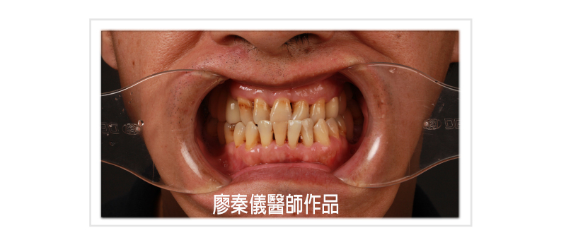 舒眠植牙,無痛植牙,TCI舒眠牙醫治療,TCI舒眠植牙,無痛植牙,新竹缺牙,新竹牙齒缺牙,竹北缺牙,竹北牙齒缺牙