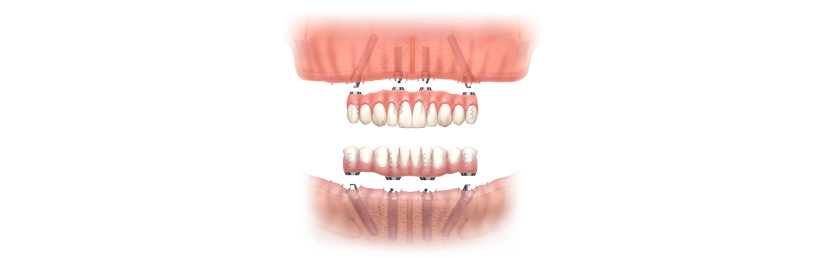 ALL ON 4 全口重建，ALL ON 6 全口重建，ALL ON 4 一日全口重建，ALL ON 6 一日全口重建，全口植牙