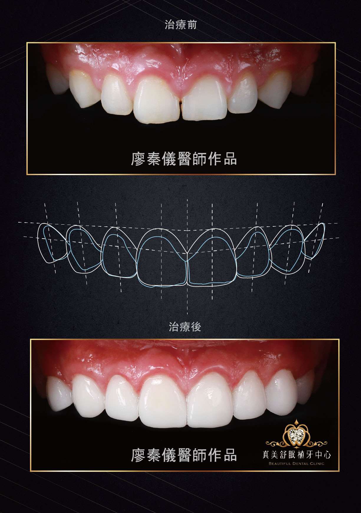 3D齒雕,3D齒雕費用,C美容牙科,小A辣